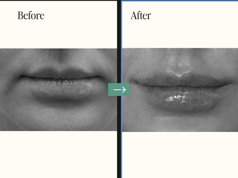 Dermal Fillers and Injectables Before and After Pictures Charleston County, SC